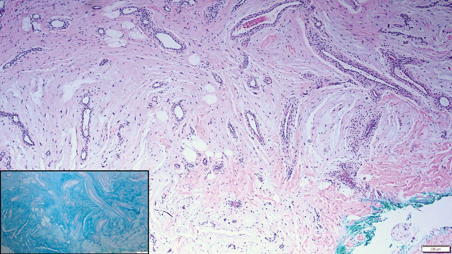 H&E, original magnification ×10 (reference bar indicates 200 μm). Inset: colloidal iron stain, original magnification ×10 (reference bar indicates 50 μm).
