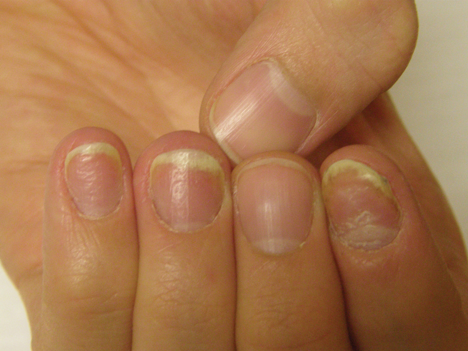 nail psoriasis signs and symptoms)
