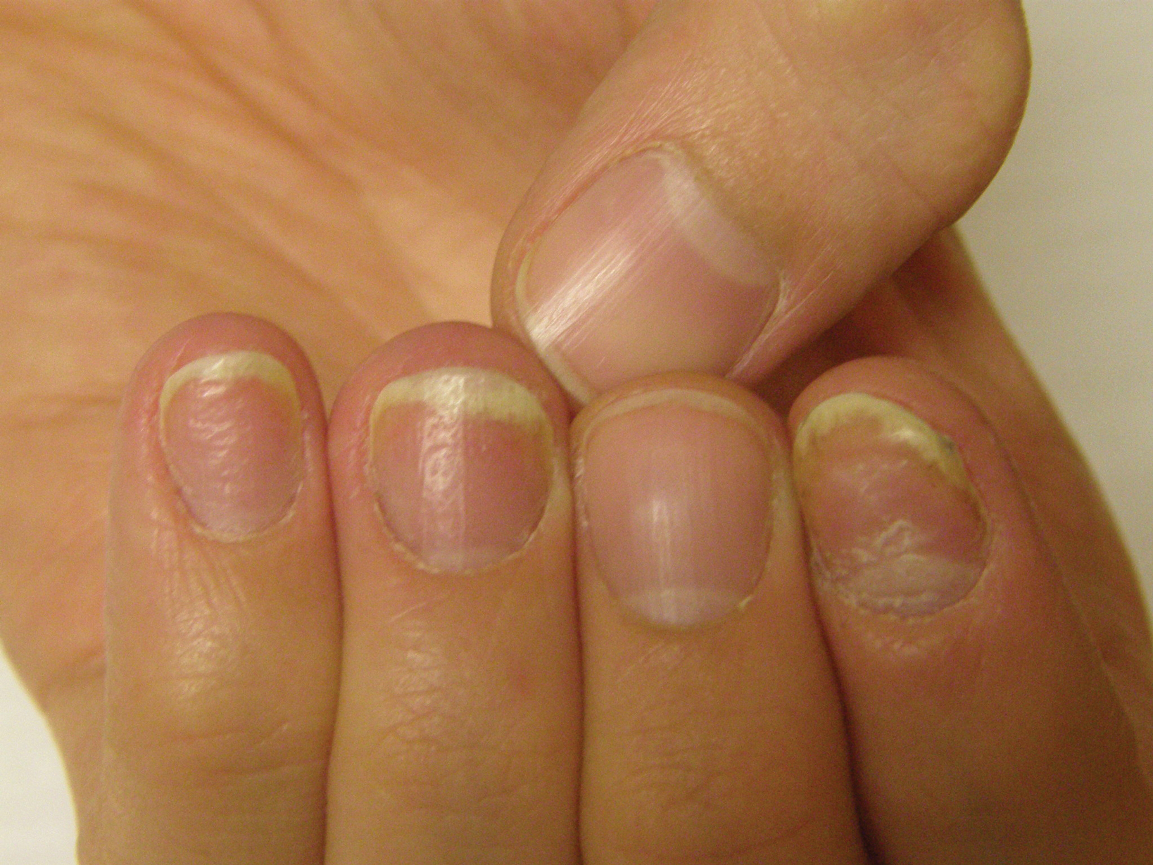 Nail psoriasis treatment guidelines