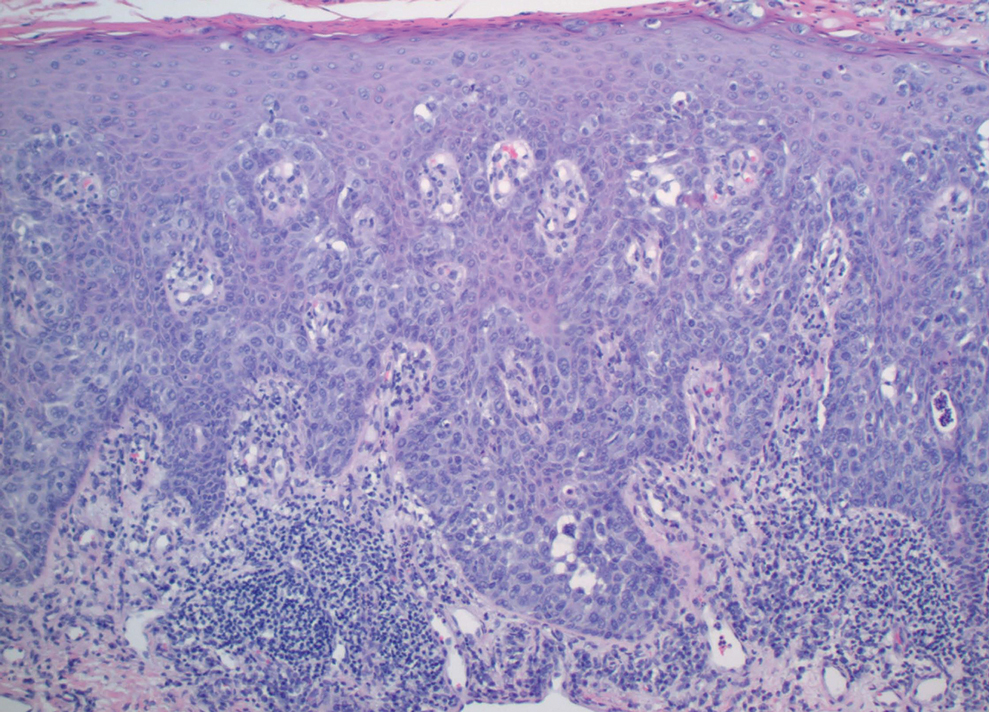 Histopathology showed carcinomatous hyperplasia comprising atypical poroid aggregates studded with multiple early ductal structures (H&E, original magnification ×40).