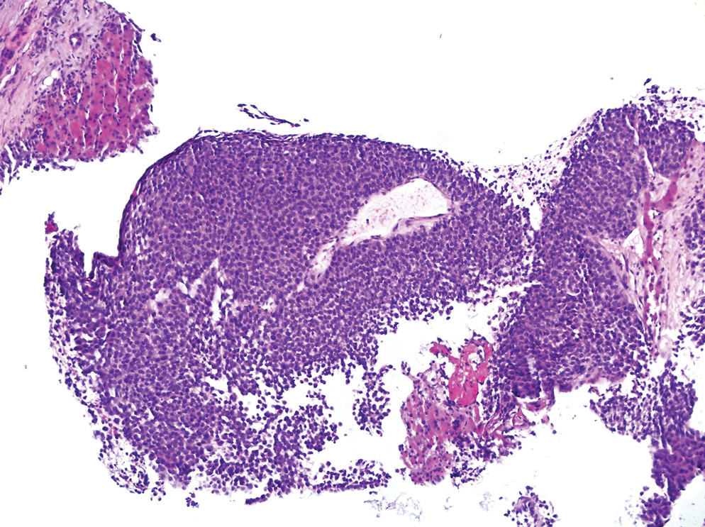 Histopathology of a liver biopsy revealed metastatic melanoma adjacent to uninvolved liver parenchyma as well as large nests and sheets of tumor with frequent mitotic figures (H&E, original magnification ×100).