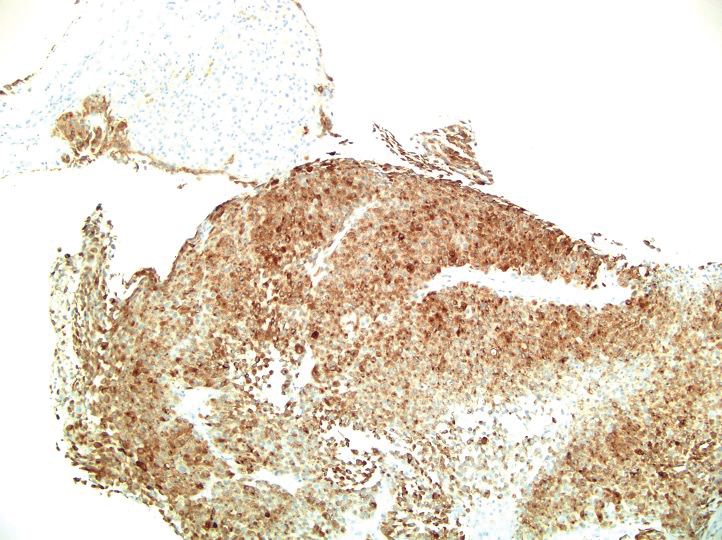 Neoplastic cells of metastatic melanoma demonstrated strong and diffuse staining with MART-1 (also known as Melan-A and melanoma-associated antigen recognized by T cells) immunostain (original magnification ×100).