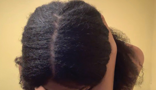 Vertex scalp