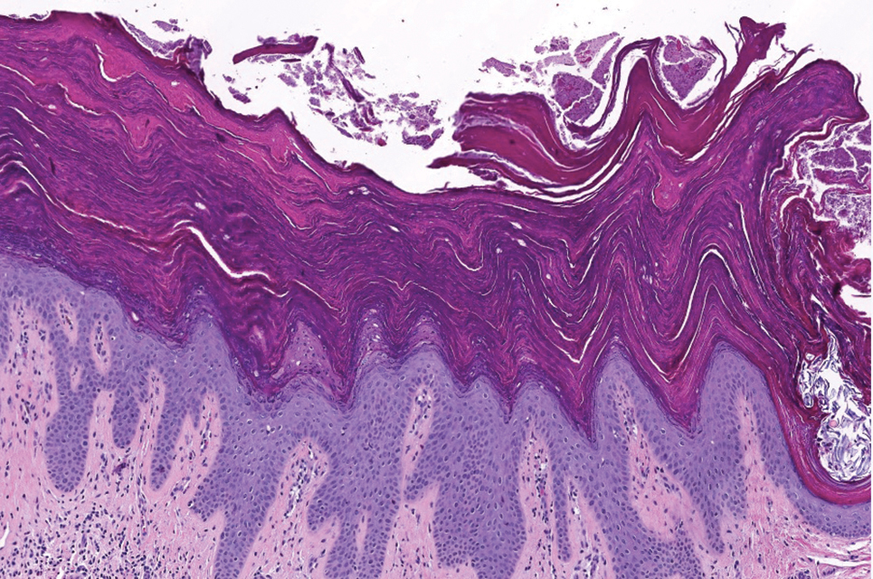 Histopathology revealed diffuse parakeratosis with retention of keratohyalin granules throughout the stratum corneum consistent with a diagnosis of granular parakeratosis (H&E, original magnification ×100).