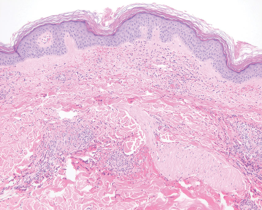 A biopsy from the left dorsal forearm showed superficial dermal perivascular extravasation of erythrocytes, neutrophils, eosinophils, and leukocytoclasis surrounding blood vessels associated with fibrin (H&E, original magnification ×10).