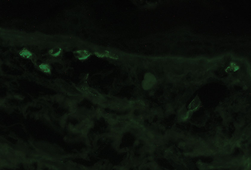 Direct immunofluorescence obtained from perilesional skin of the left forearm showed granular deposition of IgA, complement component 3, and fibrinogen in a superficial dermal vascular pattern (IgA, original magnification ×40).