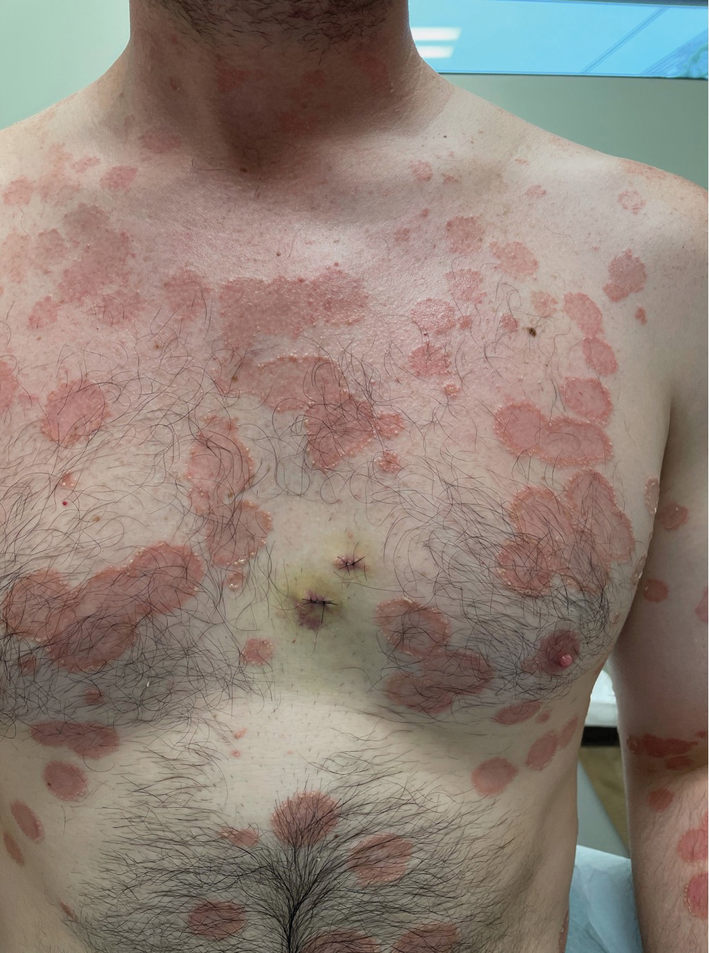 Painful and pruritic eruptions on the entire body