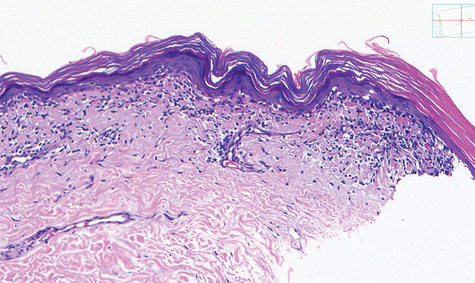 Histopathology revealed an atypical lymphoid infiltrate with expanded cytoplasm and hyperchromatic nuclei of irregular contours in the dermoepidermal junction (H&E, original magnification ×40).