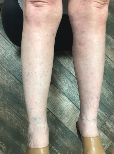 A clinical photograph taken 5 months after initial presentation showed the results of treatment with fluconazole and doxycycline. The lesions had resolved and there was no pruritus.