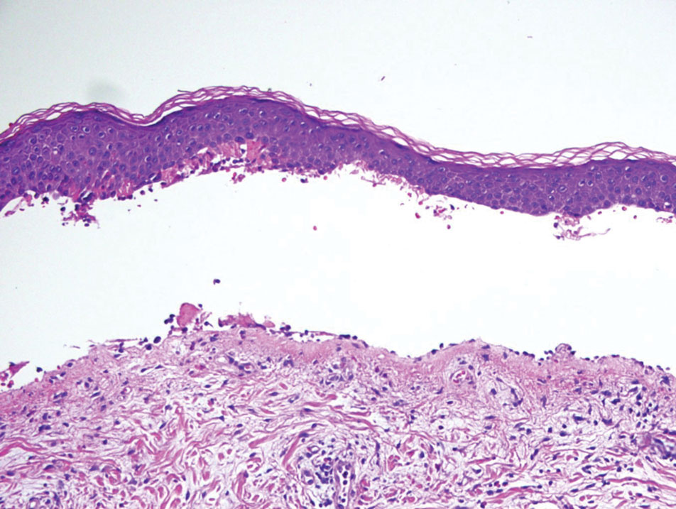 Bullous pemphigoid. An eosinophil-rich subepidermal blister is present (H&E, original magnification ×200).