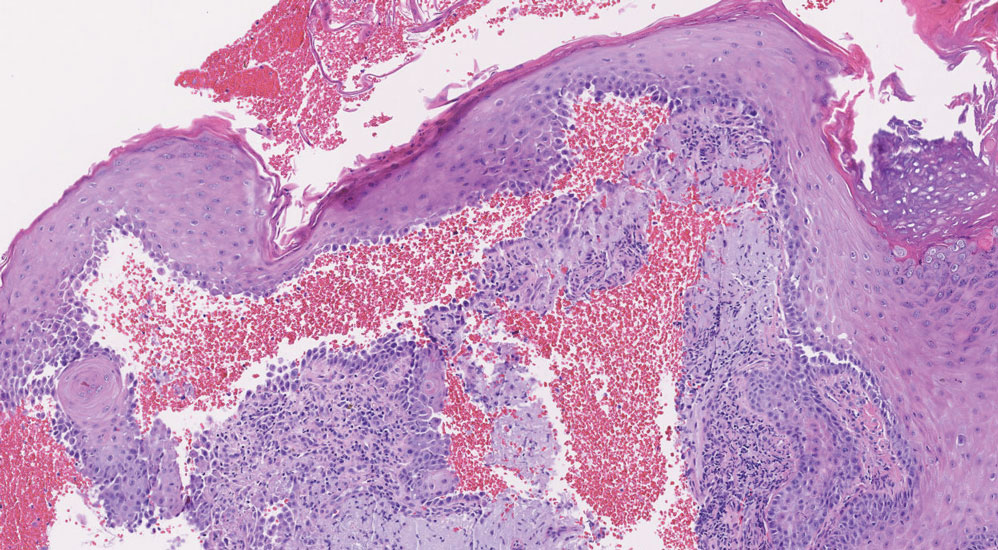 Paraneoplastic pemphigus. Acantholysis, hemorrhagic bullae formation, and suprabasilar dyscohesion are present (H&E, original magnification ×100).