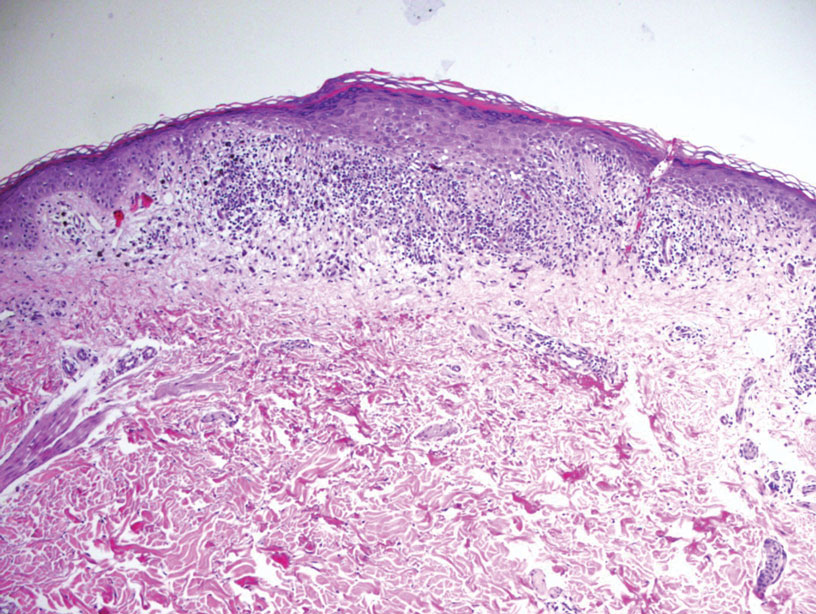 Classic lichen planus. Lichenoid interface dermatitis at the dermoepidermal junction (H&E, original magnification ×100).