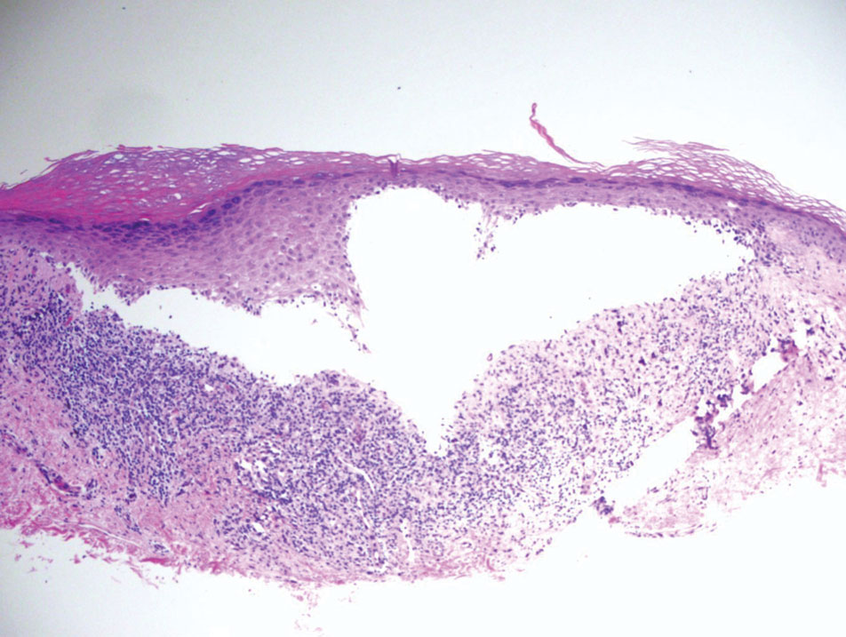 Bullous lichen planus. A Max-Joseph space is visible due to a lichenoid infiltrate and degeneration of basal keratinocytes (H&E, original magnification ×100).