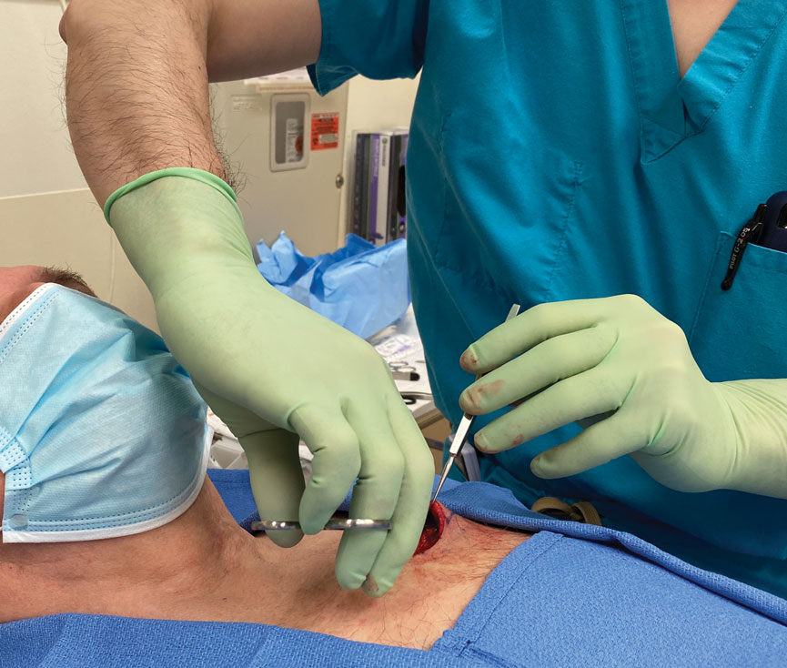 Undermining tissue between the 3-o’clock and 6-o’clock positions often requires a shift in entire body position or stretching over the surgical field to obtain adequate reach, which can strain the shoulder and limit efficiency.