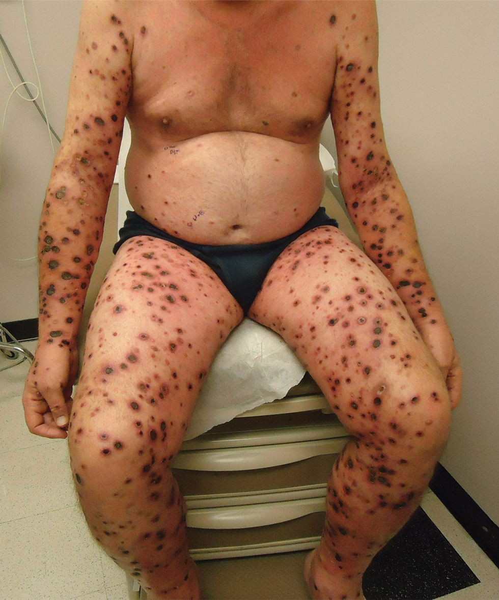 Febrile ulceronecrotic Mucha-Habermann disease. Ulcerative and crusted violaceous papules on the extremities and trunk.