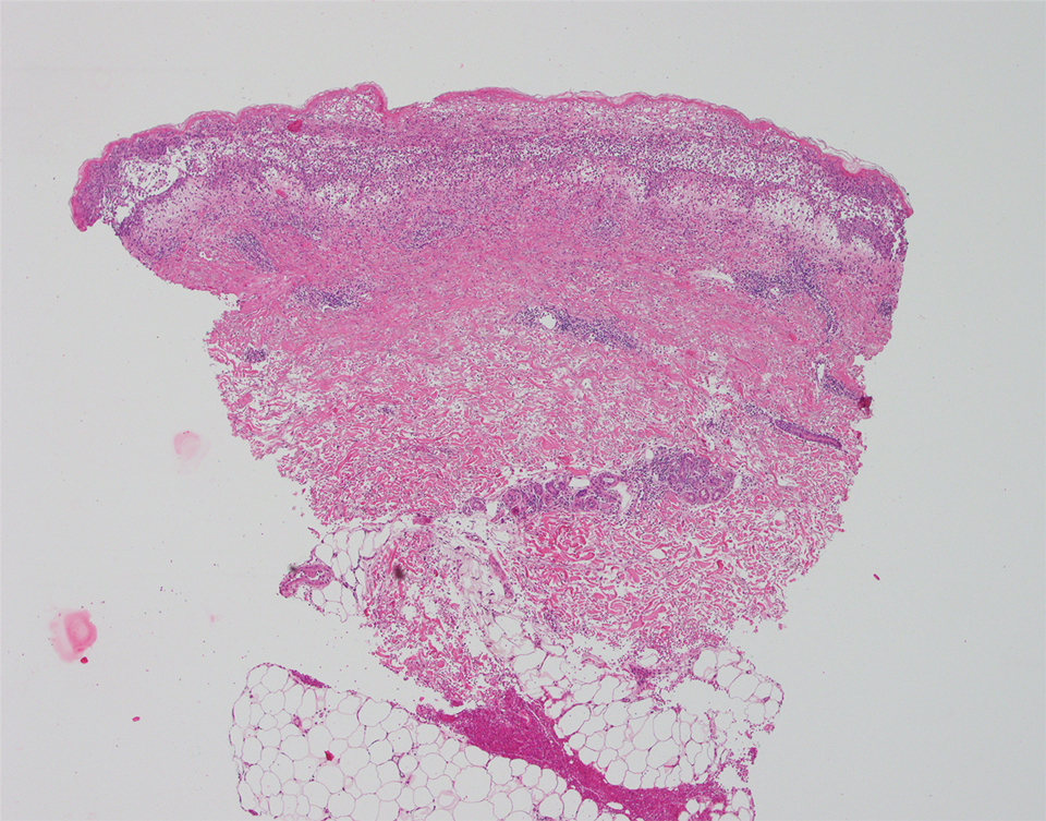 Histopathology showed a lichenoid infiltrate and a wedge-shaped lymphocytic perivascular infiltrate