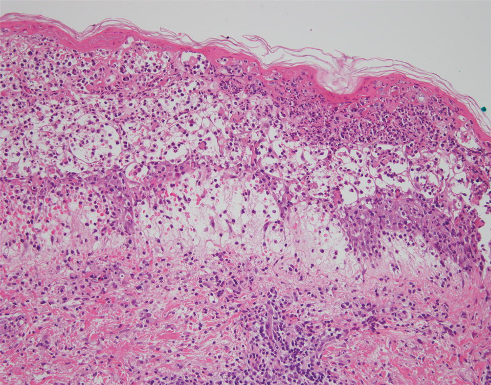 Histopathology showed extravasated erythrocytes and lymphocytes