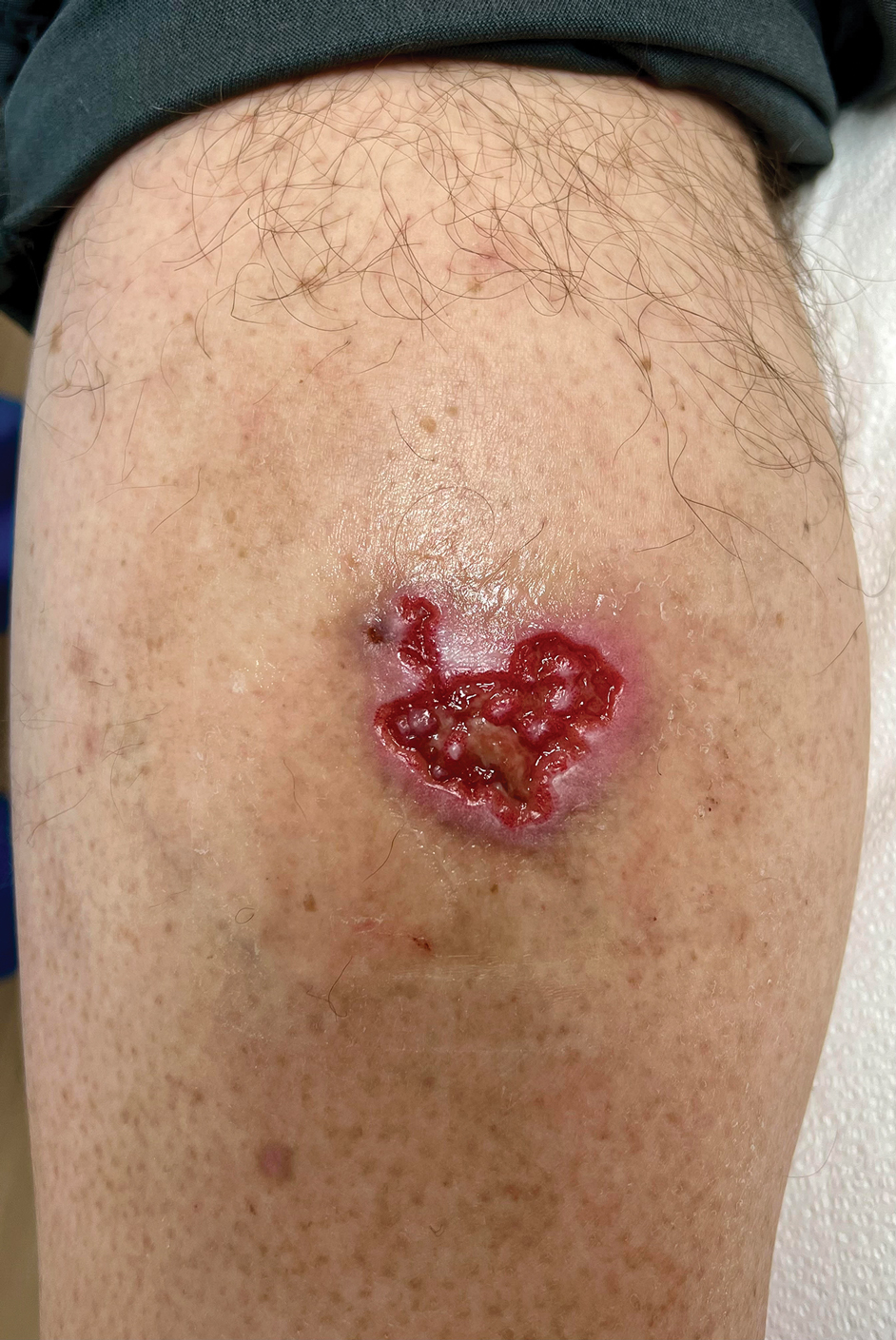 Chronic cribriform ulcerated plaque on the left calf