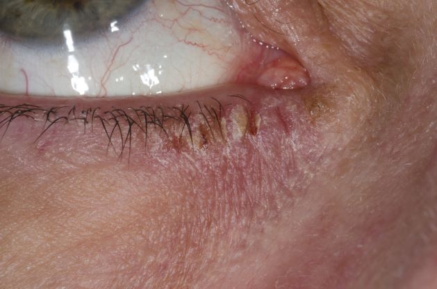 Woman Presents With Burning Itchy Red Eyes Atopic Dermatitis 