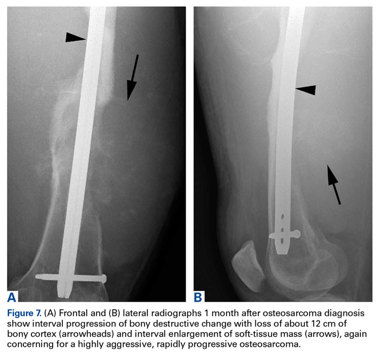 Malignant Transformation Of An Aneurysmal Bone Cyst To Fibroblastic Osteosarcoma Mdedge Surgery 6193