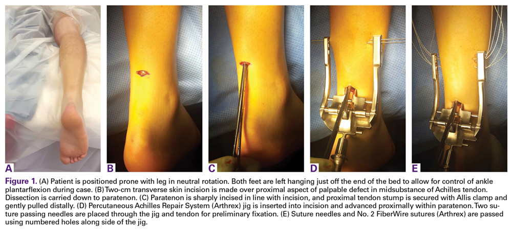 Arthrex - Compression SpeedBridge™ Rotator Cuff Repair