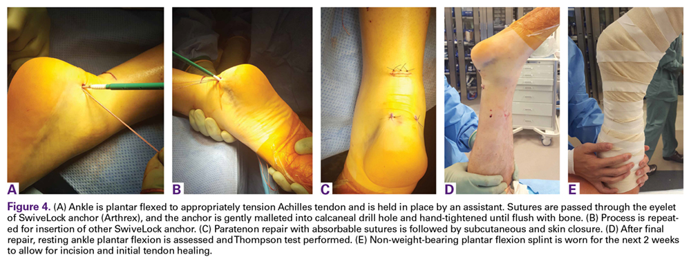 Limited Incision Knotless Achilles Tendon Repair Mdedge Surgery