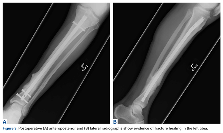 Removal of the Distal Aspect of a Broken Tibial Nail | MDedge Surgery