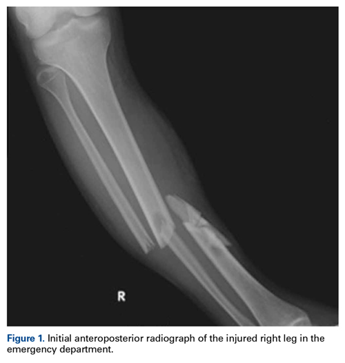 Lower leg fracture