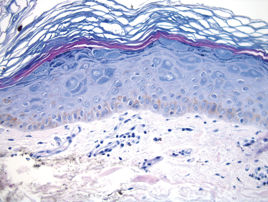 Acanthosis with prominent hypergranulosis and enlarged keratinocytes with blue-gray cytoplasm (H&E, original magnification ×40).