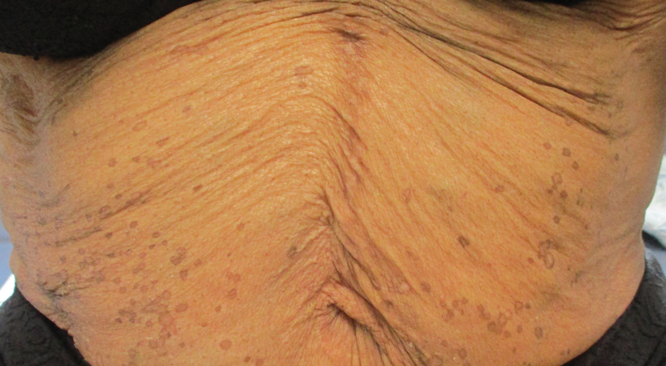 Eruptive Annular Papules on the Trunk of an Organ Transplant Recipient