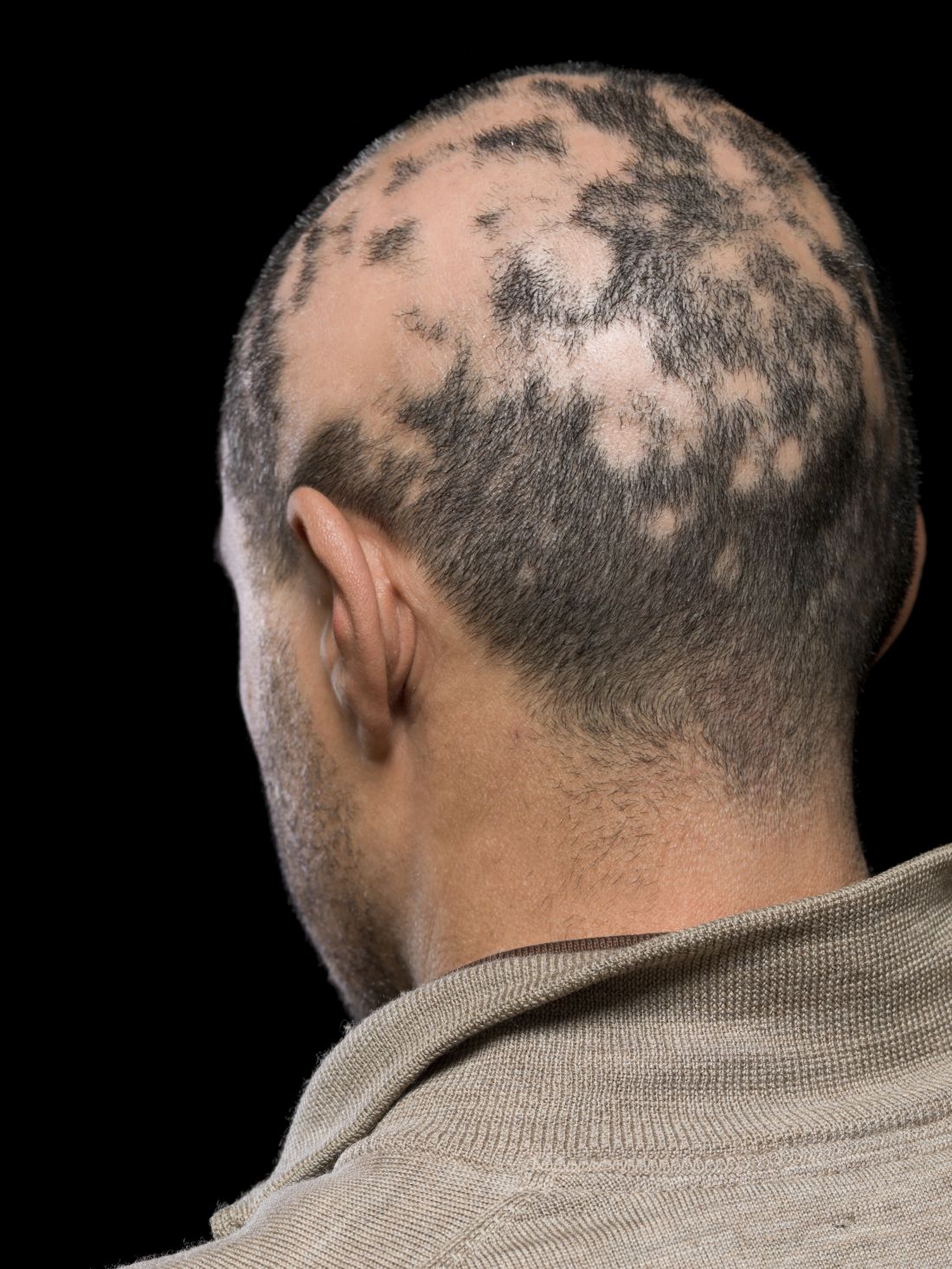 Current Alopecia Areata Options Include Old And New Therapies Mdedge