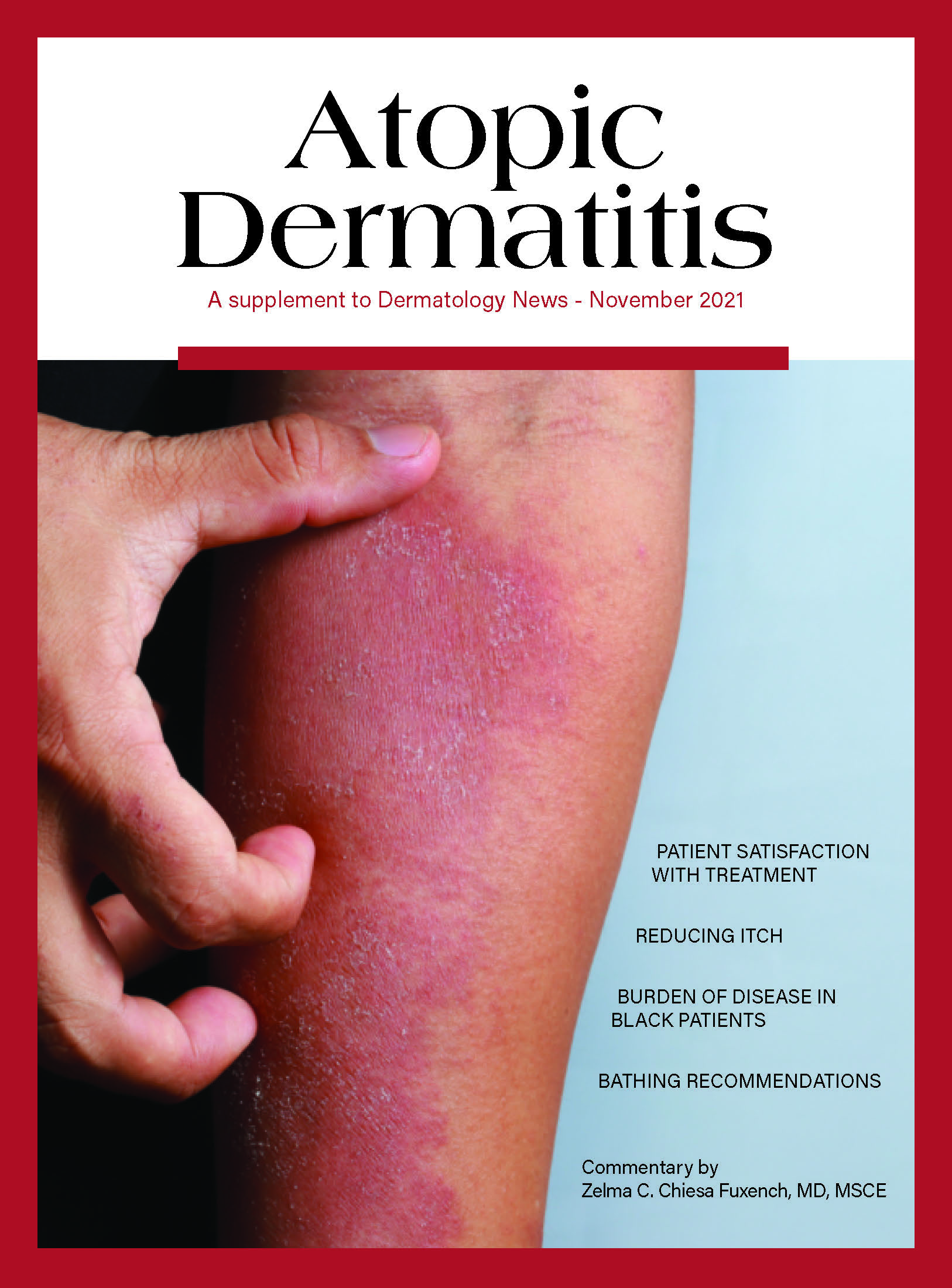 https://cdn.mdedge.com/files/s3fs-public/atopicdermatitis_cover_0.jpg