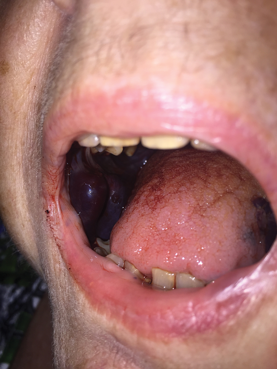 Hemorrhagic bullae of the buccal mucosae.