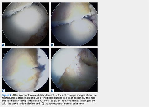 Ankle arthroscopic images