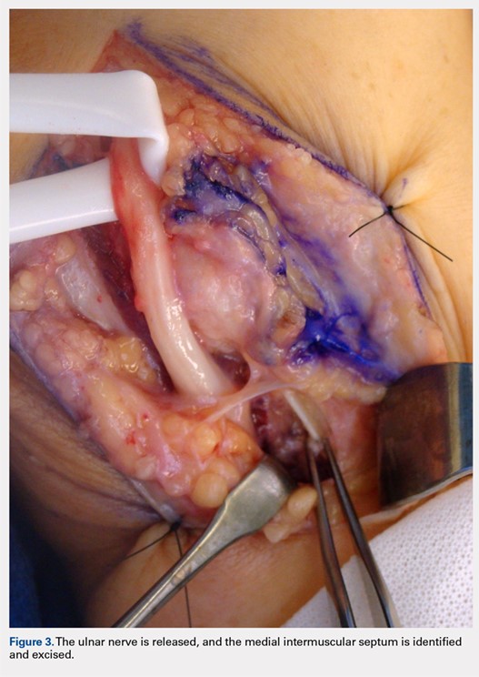 1. Potential sites of ulnar nerve compression: (1) intermuscular