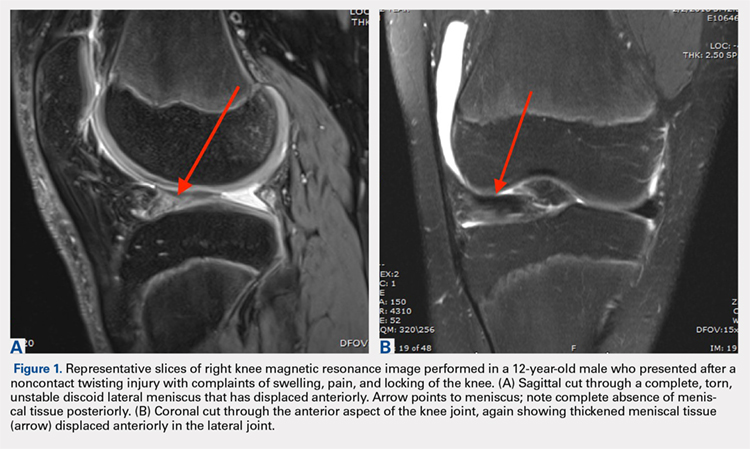 Representative slives of right knee magnetic resonance image performed in a 12-year-old male who presented after a noncontact twisting injury with complaints of swlling, pain, and locking of the knee.