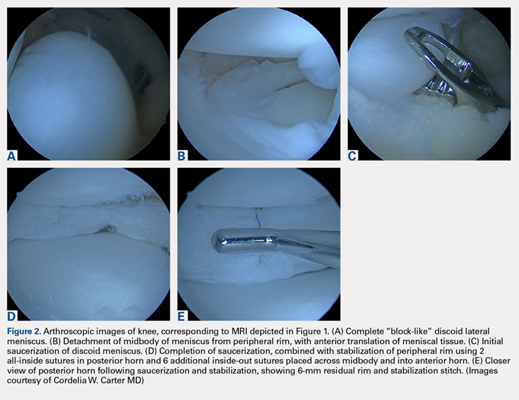 Arthroscopic images of knee, corresponding to MRI depicted in Figure 1.