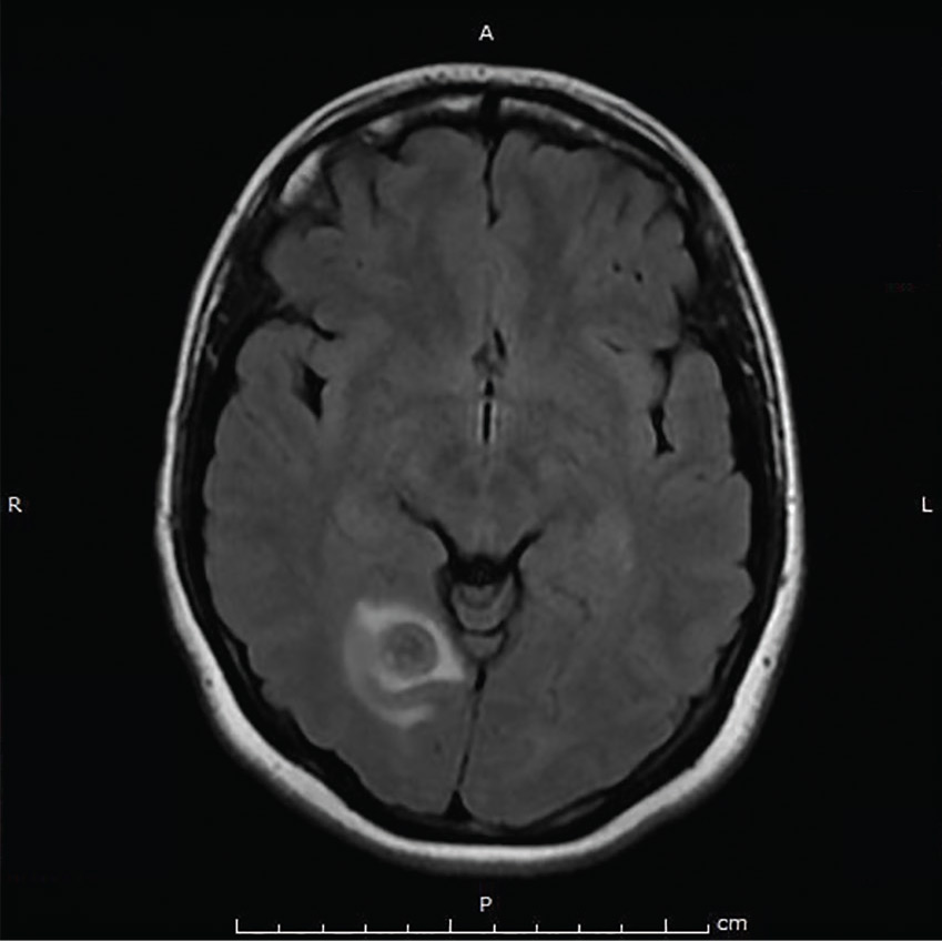 MRI 2 months later showed partial resolution of the cystic lesion within the right occipital lobe