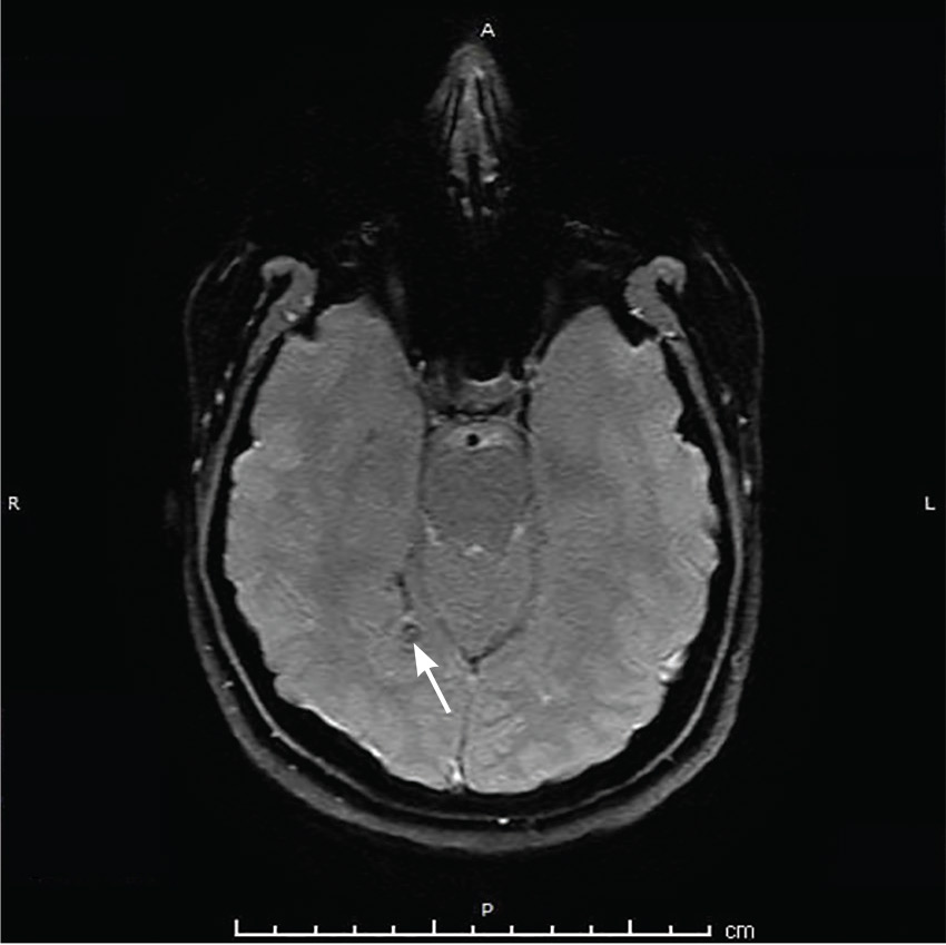 Susceptibility-weighted MRI 3 years later for a flare in migraines showed a healed, indolent, right-occipital neurocysticercotic lesion and no evidence of an active process.