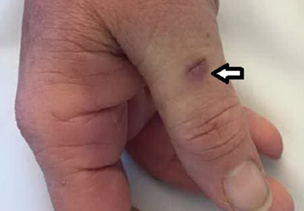 Laceration (arrow) on patient’s right thumb from a dog bite