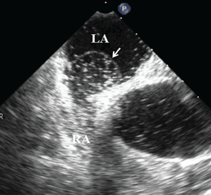 TEE with intravenous injection of agitated saline demonstrating shunting from the right atrium to the left atrium.