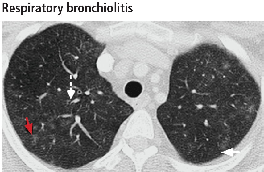 Respiratory bronchiolitis