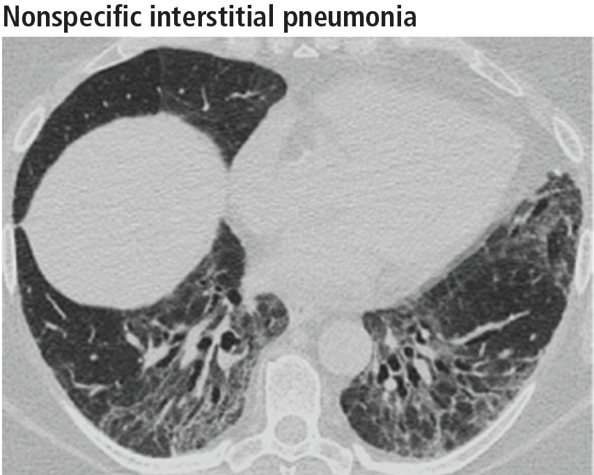 Nonspecific interstitial pneumonia