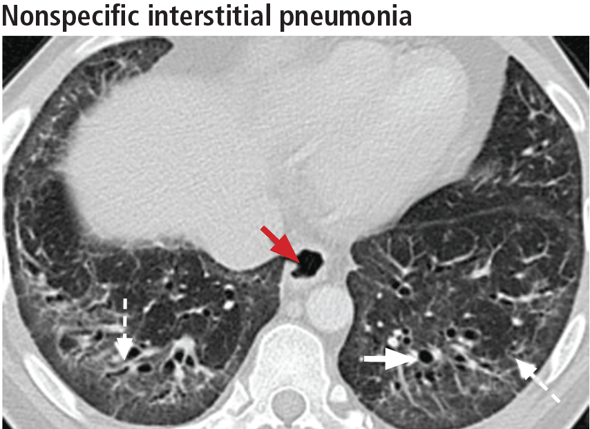 Nonspecific interstitial pneumonia