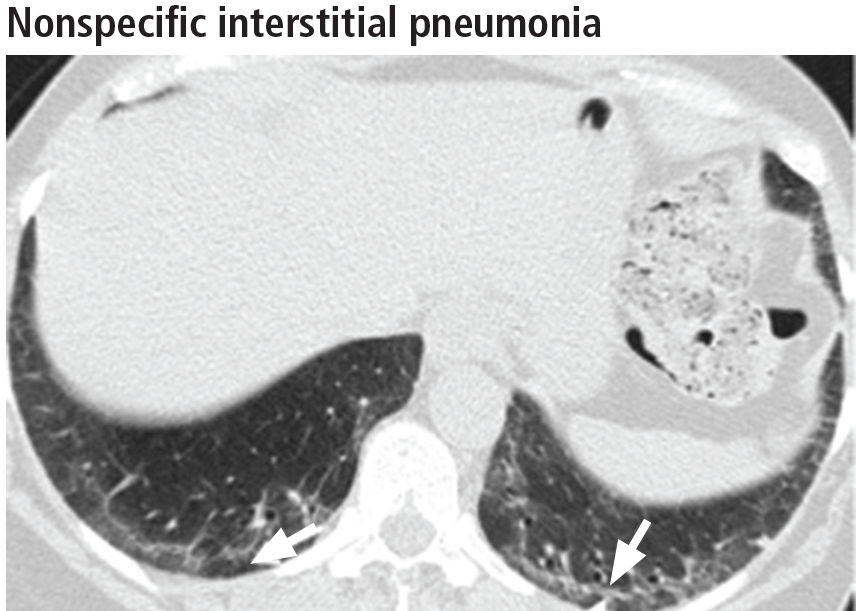 Nonspecific interstitial pneumonia