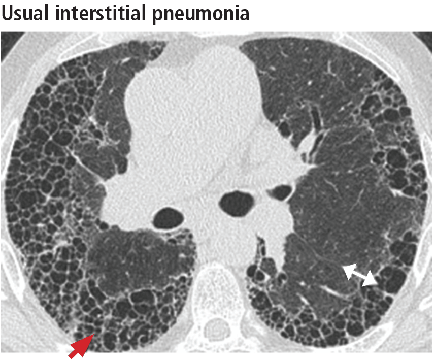 Usual interstitial pneumonia