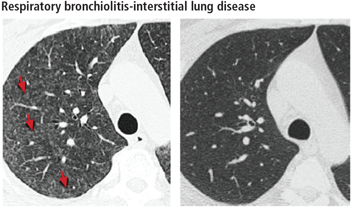 Respiratory bronchiolitis-interstitial lung disease