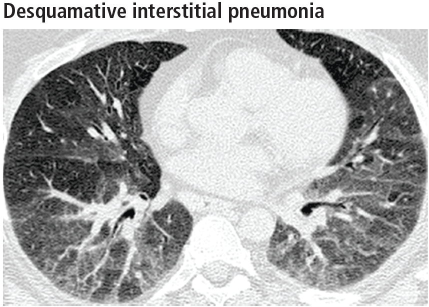 Desquamative interstitial pneumonia