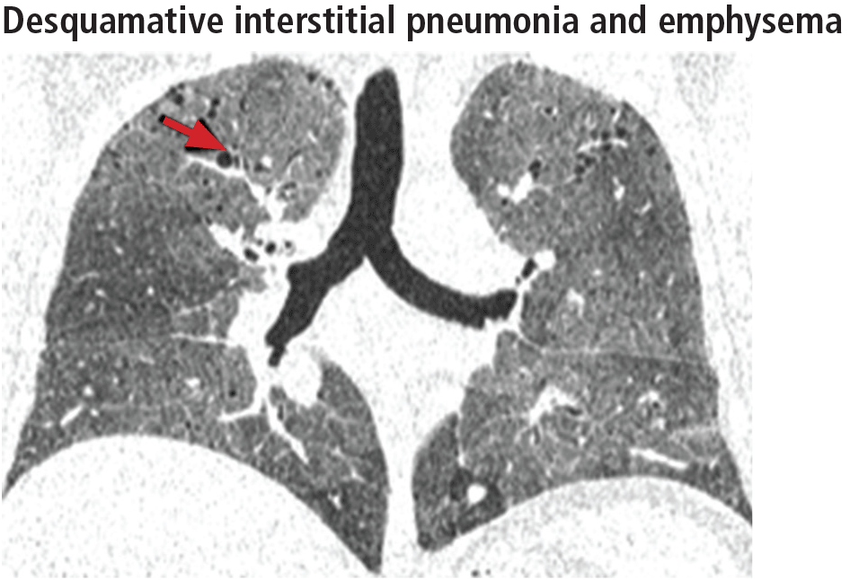 Desquamative interstitial pneumonia and emphysema