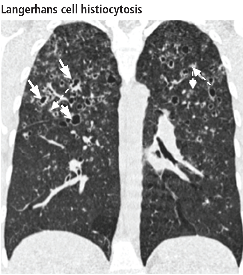 Langerhans cell histiocytosis